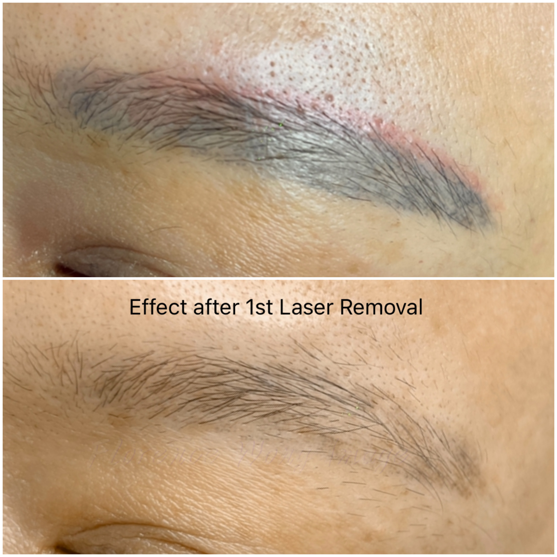 Eyebrow Laser Removal Florence Wong log Professional MakeUp