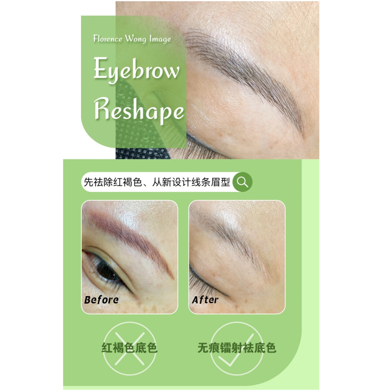 Red Base Brow ~ Laser Removal - Florence Wong Weblog - Professional ...